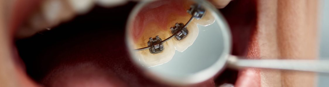 Close-up of female patient having check-up of dental braces on the back side of her teeth at dental clinic.