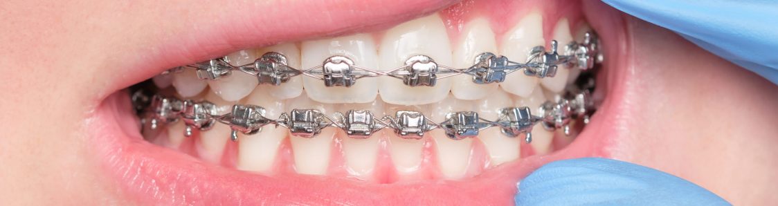 Close-up of a dentist's gloved hand opening the mouth of a patient with metal bracket system on the teeth of a young woman. Concept of oral dental health care and hygiene . Shallow depth of field